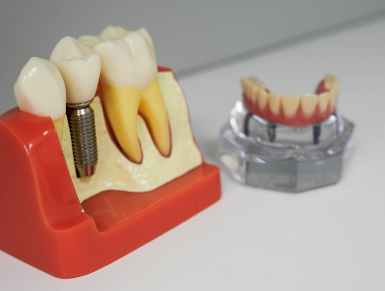 Dental implants