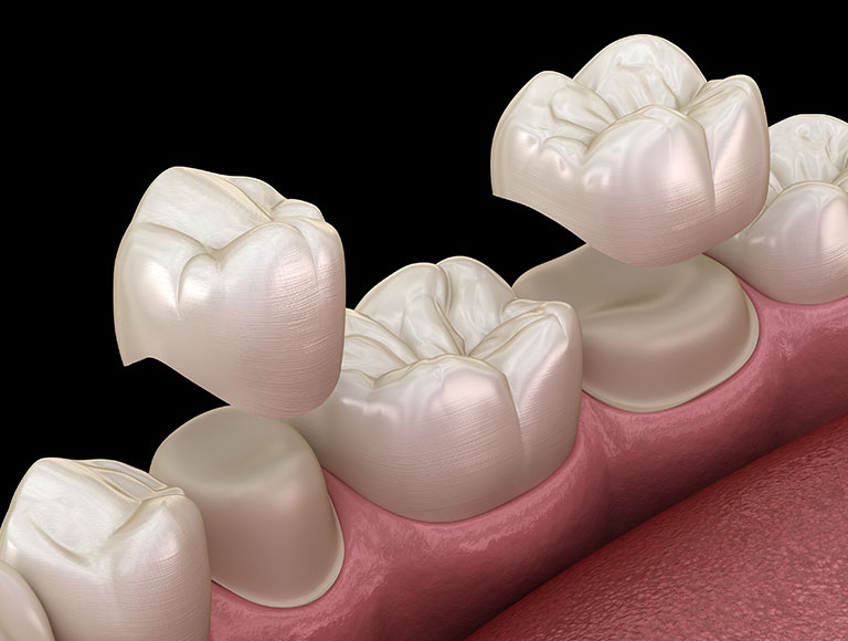Dental Crowns