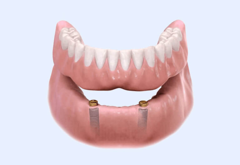 Fixed vs. Removable Implant Solutions