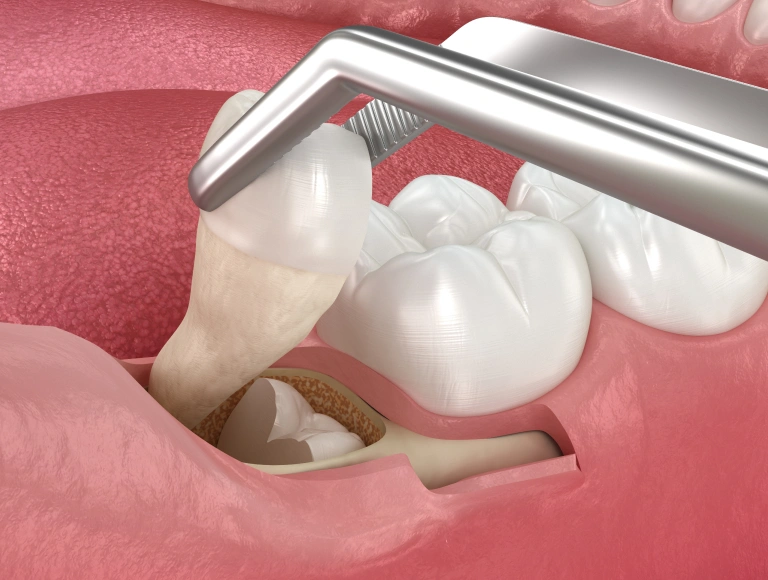 What Are Wisdom Teeth